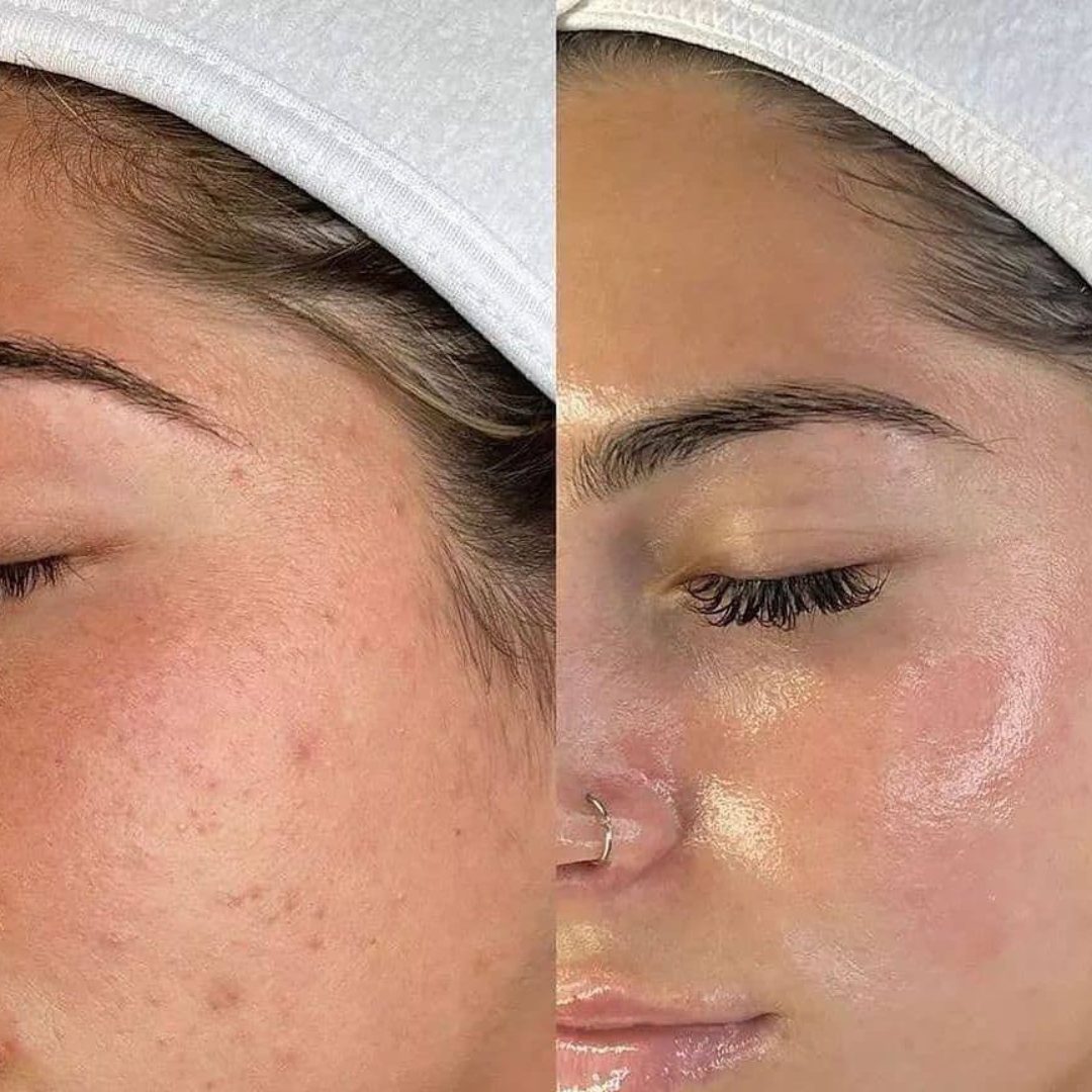 Microneedling Behandlung