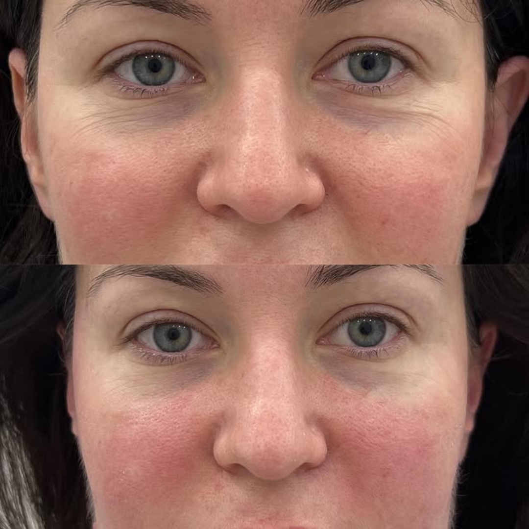 Bio Botox Behandlung