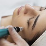 microneedling